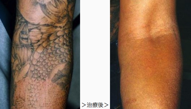 刺青除去2