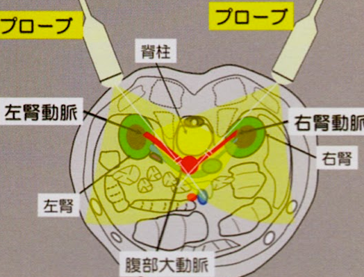 腎動脈エコー.png 腎動脈エコー