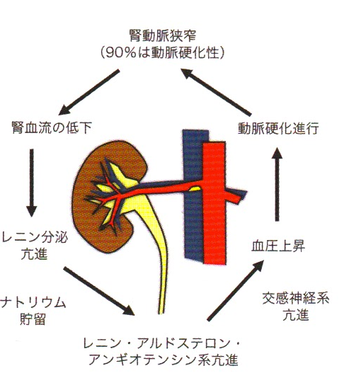 腎動脈狭窄の病態.png 腎動脈狭窄の病態