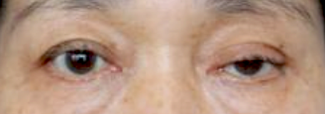 眼瞼下垂 のコピー.png 眼瞼下垂の写真