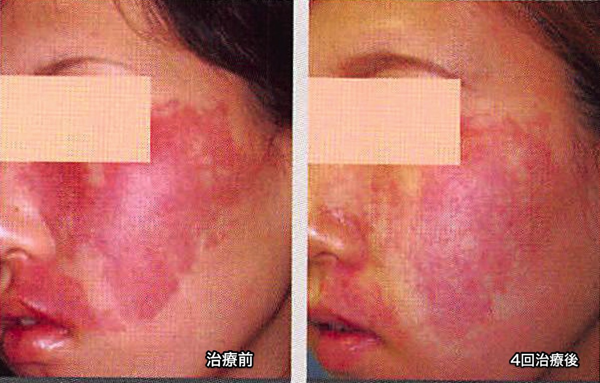 赤アザ 血管腫 毛細血管拡張症の治療に使用するvbeam パルスダイレーザー のご案内です