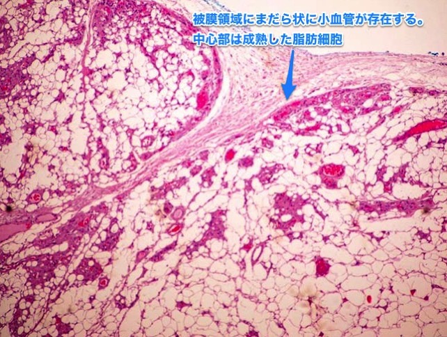 福岡,血管脂肪腫,写真