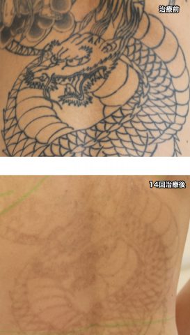 刺青除去,ピコレーザー,福岡