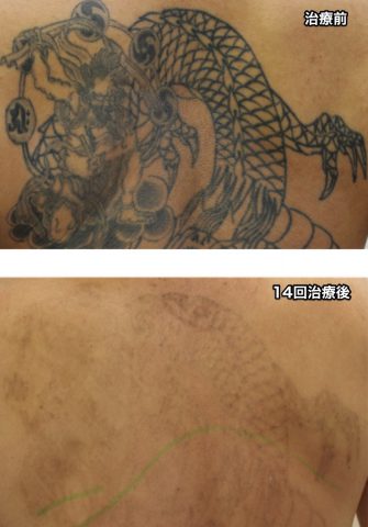 刺青除去,ピコレーザー,福岡