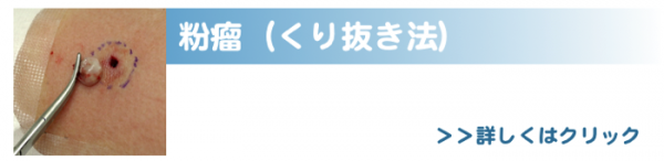 粉瘤くり抜き法バナー