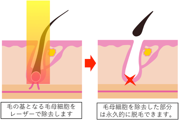 医療脱毛のしくみ・図