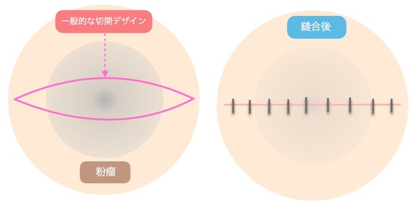 一般的な粉瘤の切開図