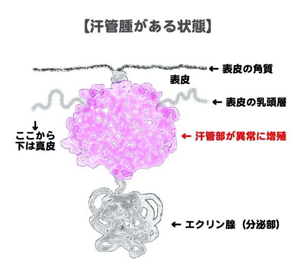 汗管腫