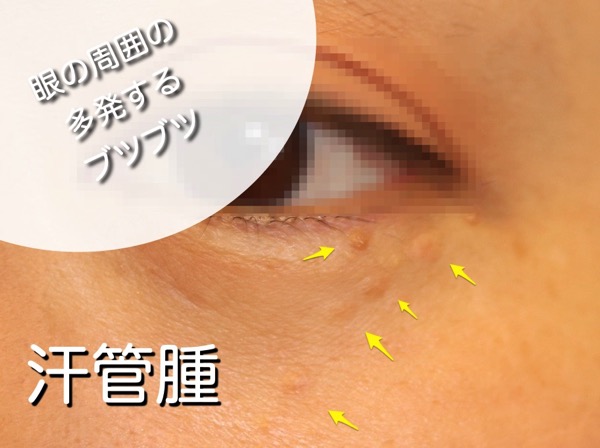 syringoma