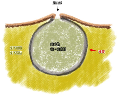 epidermalcyst