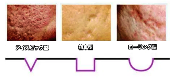 Type of acne scars