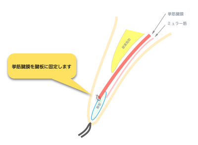 挙筋腱膜の腱板固定