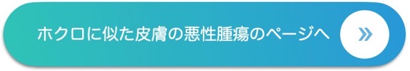 ホクロに似た皮膚の悪性腫瘍のページへ