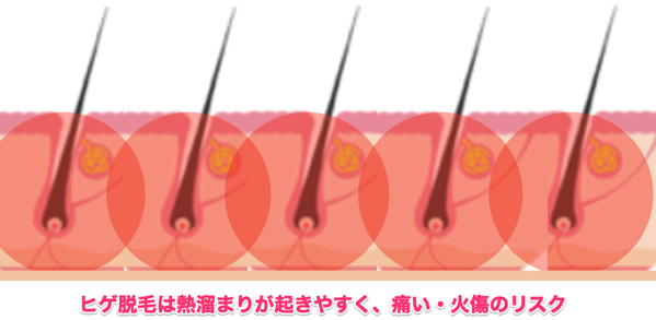 ヒゲ脱毛 熱溜まり