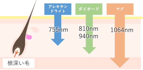 ヒゲ脱毛,レーザー種類,福岡