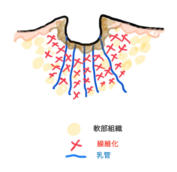 陥没乳頭グレード3