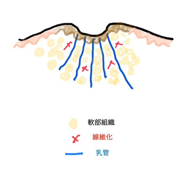 陥没乳頭グレード1