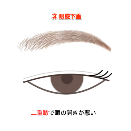 偽性眼瞼下垂症2