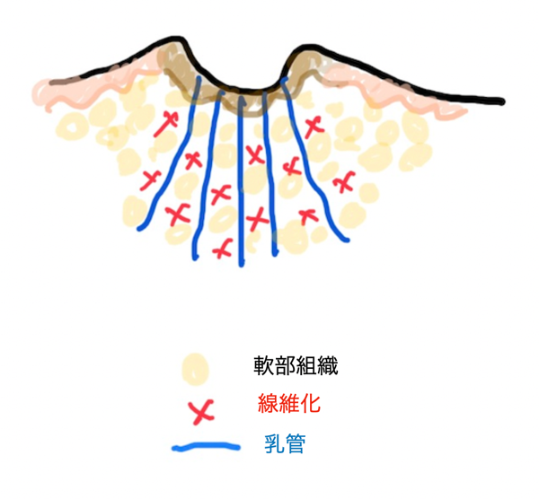 陥没乳頭グレード2