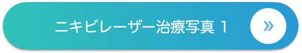 ニキビレーザー治療写真 1