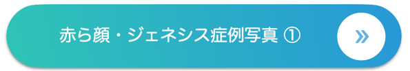 赤ら顔 ジェネシス症例写真 ①