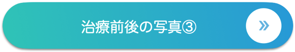 治療前後の写真③