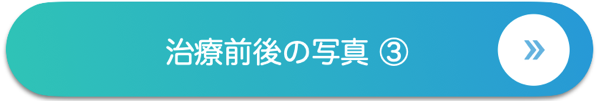 治療前後の写真 ③