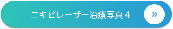 ニキビのレーザー治療