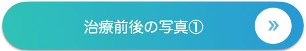 治療前後の写真①