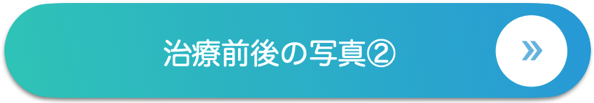 治療前後の写真②