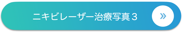 ニキビレーザー治療写真３