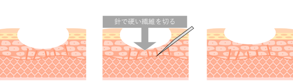 ニキビ跡サブシージョン,ローリング型