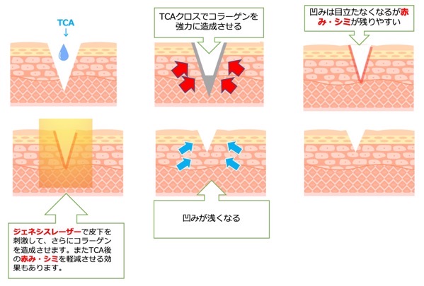 TCAクロス ニキビ跡 福岡