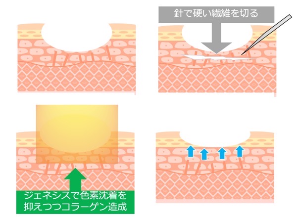 ニキビ跡 サブシージョン TCA ジェネシス福岡