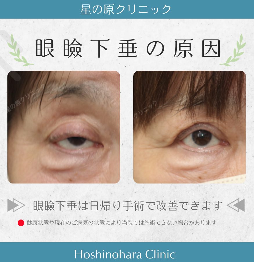 眼瞼下垂の原因