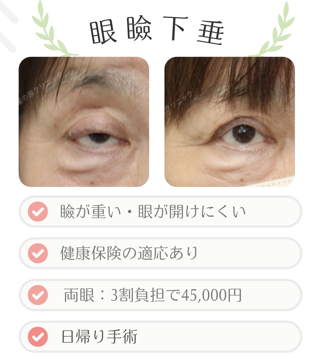 福岡での保険診療での眼瞼下垂の治療