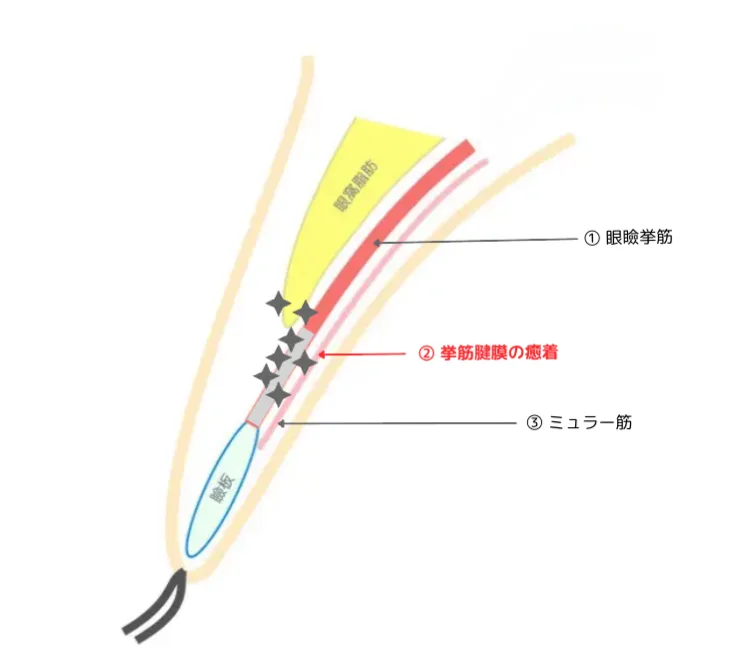 眼瞼下垂,福岡