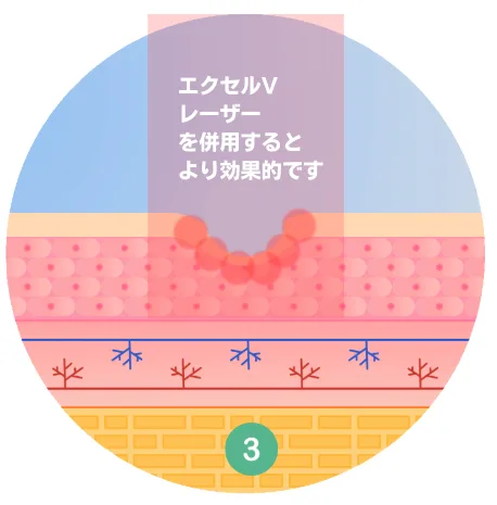 福岡,ニキビ跡,TCAクロス