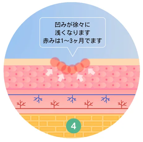 福岡,ニキビ跡,TCAクロス