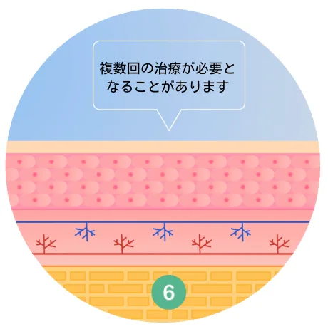 福岡,ニキビ跡,TCAクロス