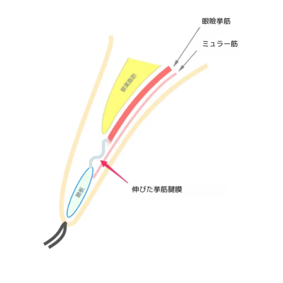 眼瞼下垂福岡