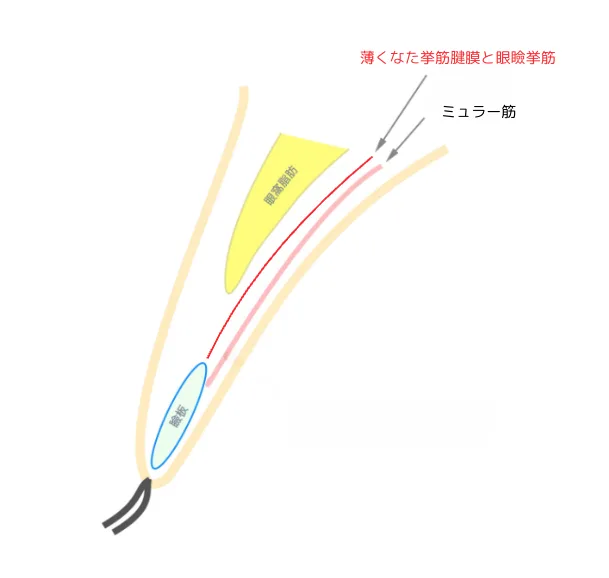 福岡眼瞼下垂