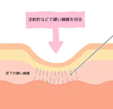 サブシージョン2