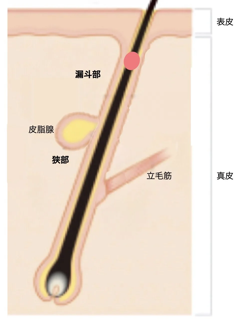 粉瘤の穴