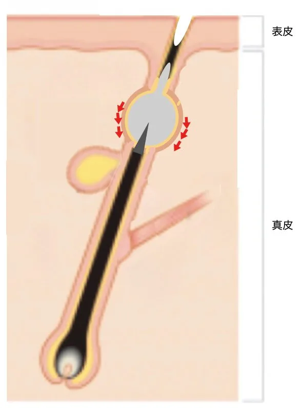 粉瘤の穴