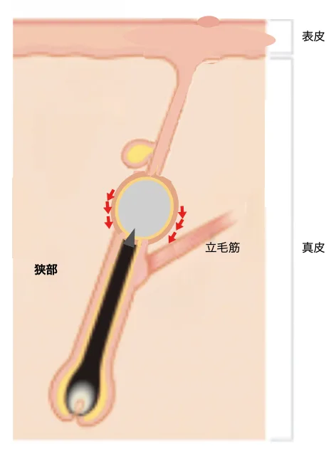 粉瘤の穴