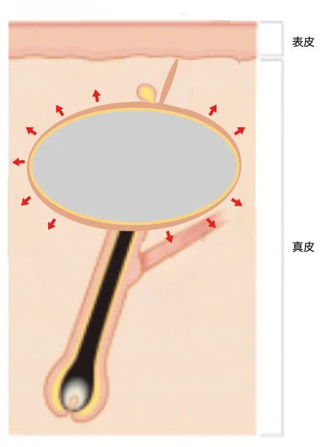粉瘤の穴