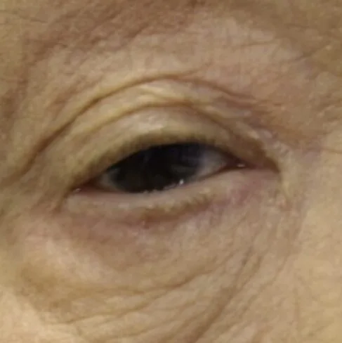 福岡の保険診療での眼瞼下垂・三重瞼