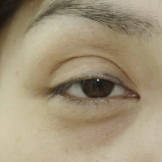 福岡の保険診療での眼瞼下垂・三重瞼