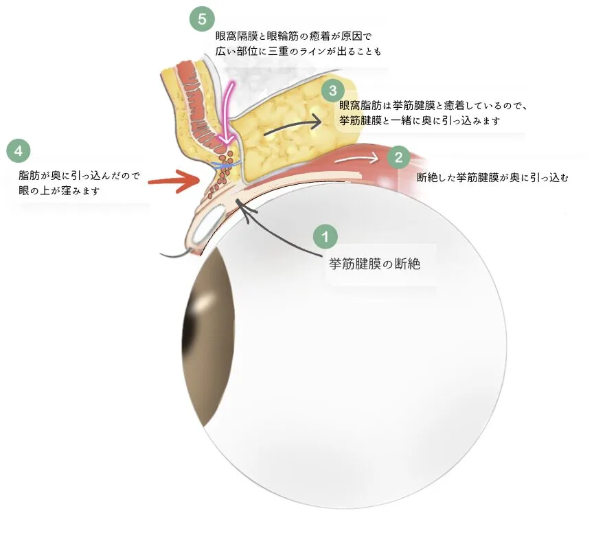 眼瞼下垂 三重 凹み 福岡保険診療